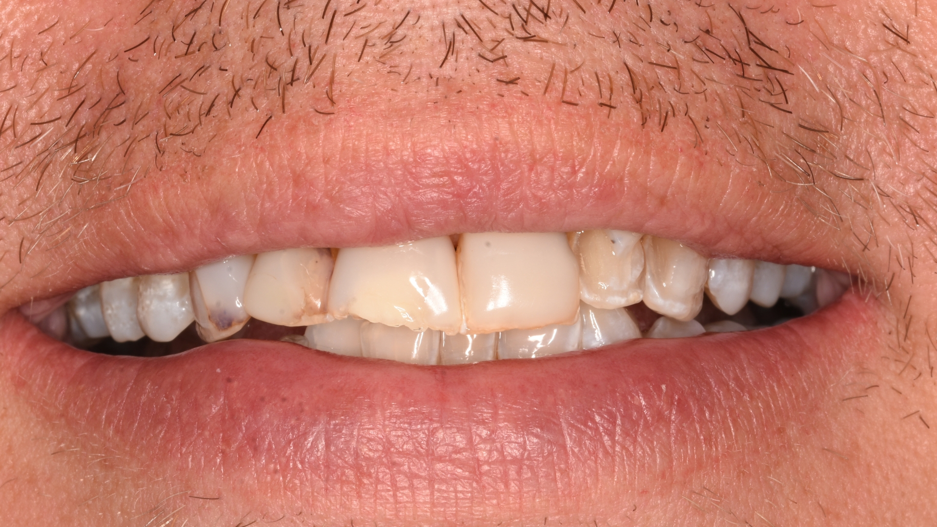 Smile makeover before
