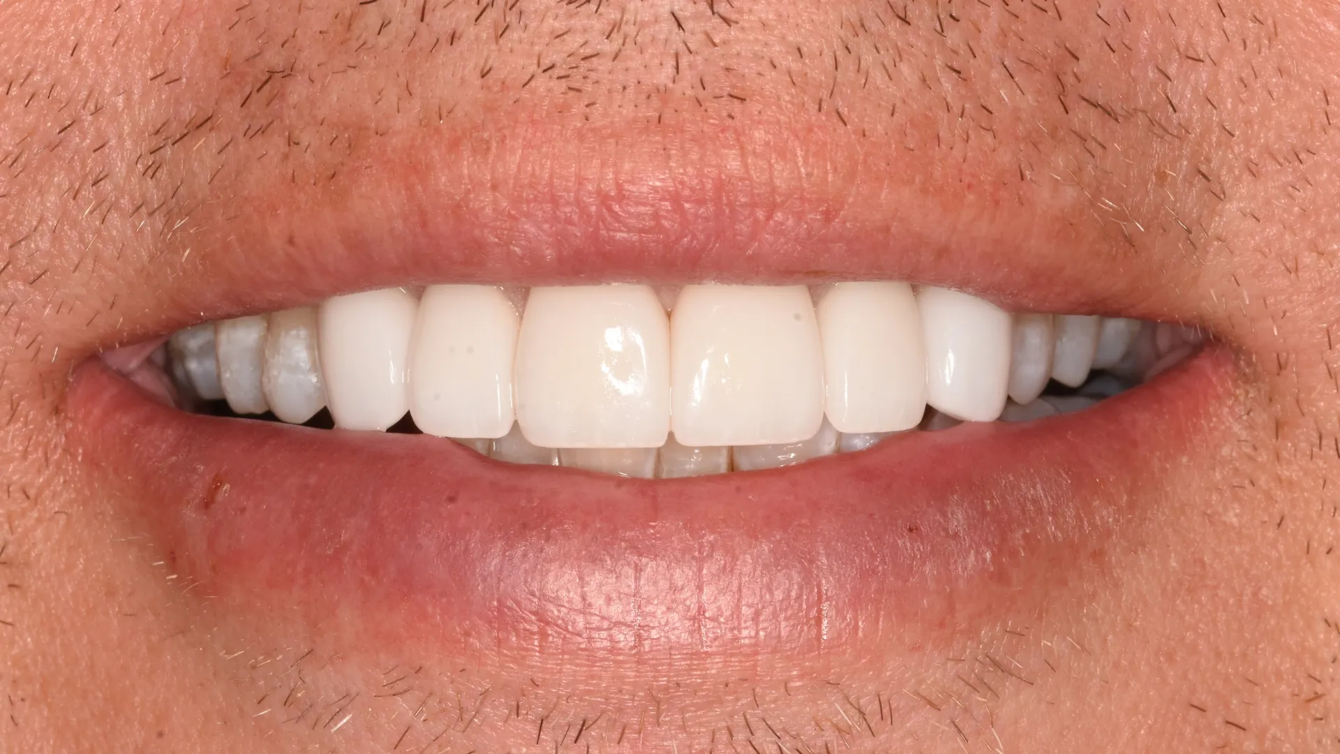 Smile makeover after