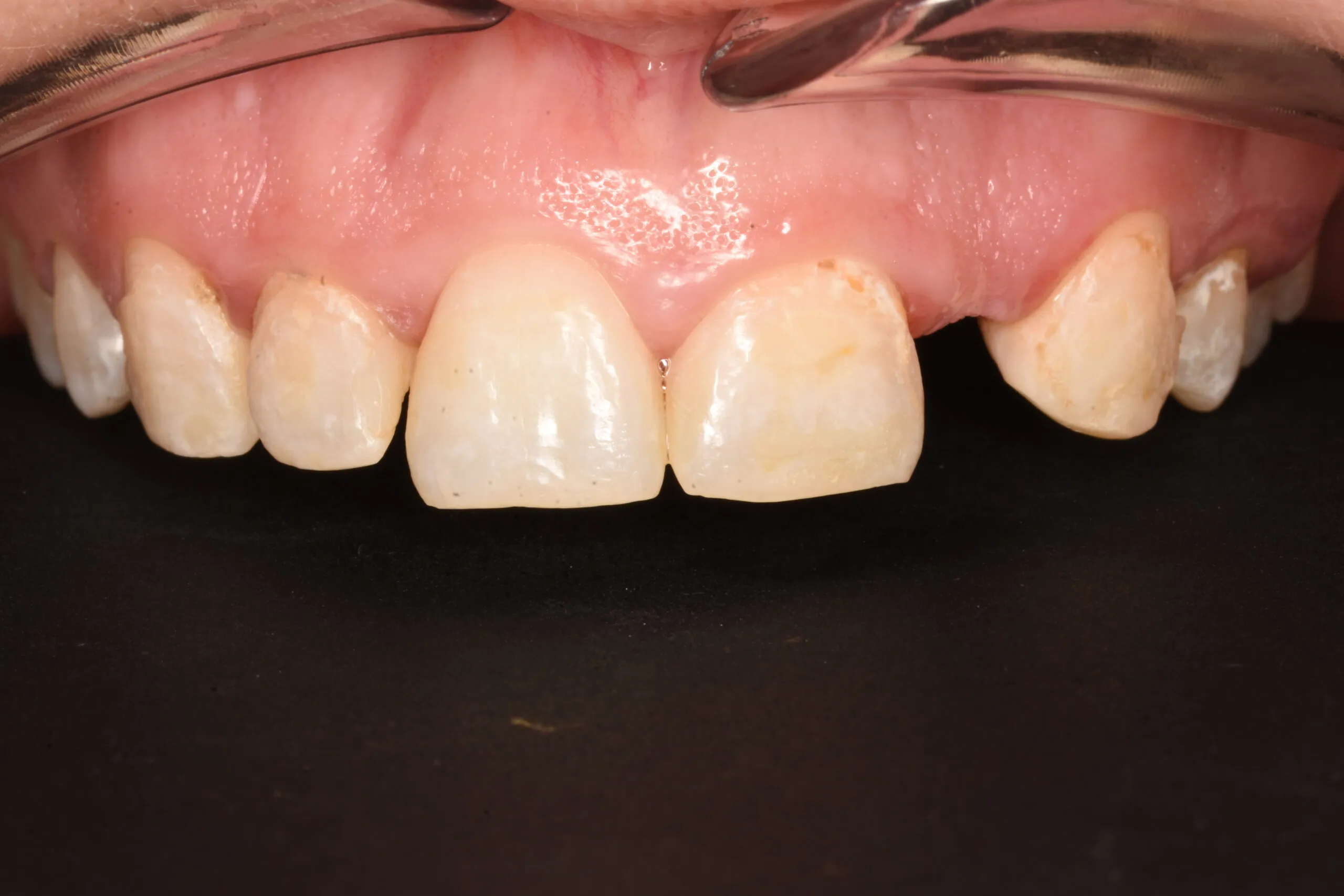 Smile makeover before