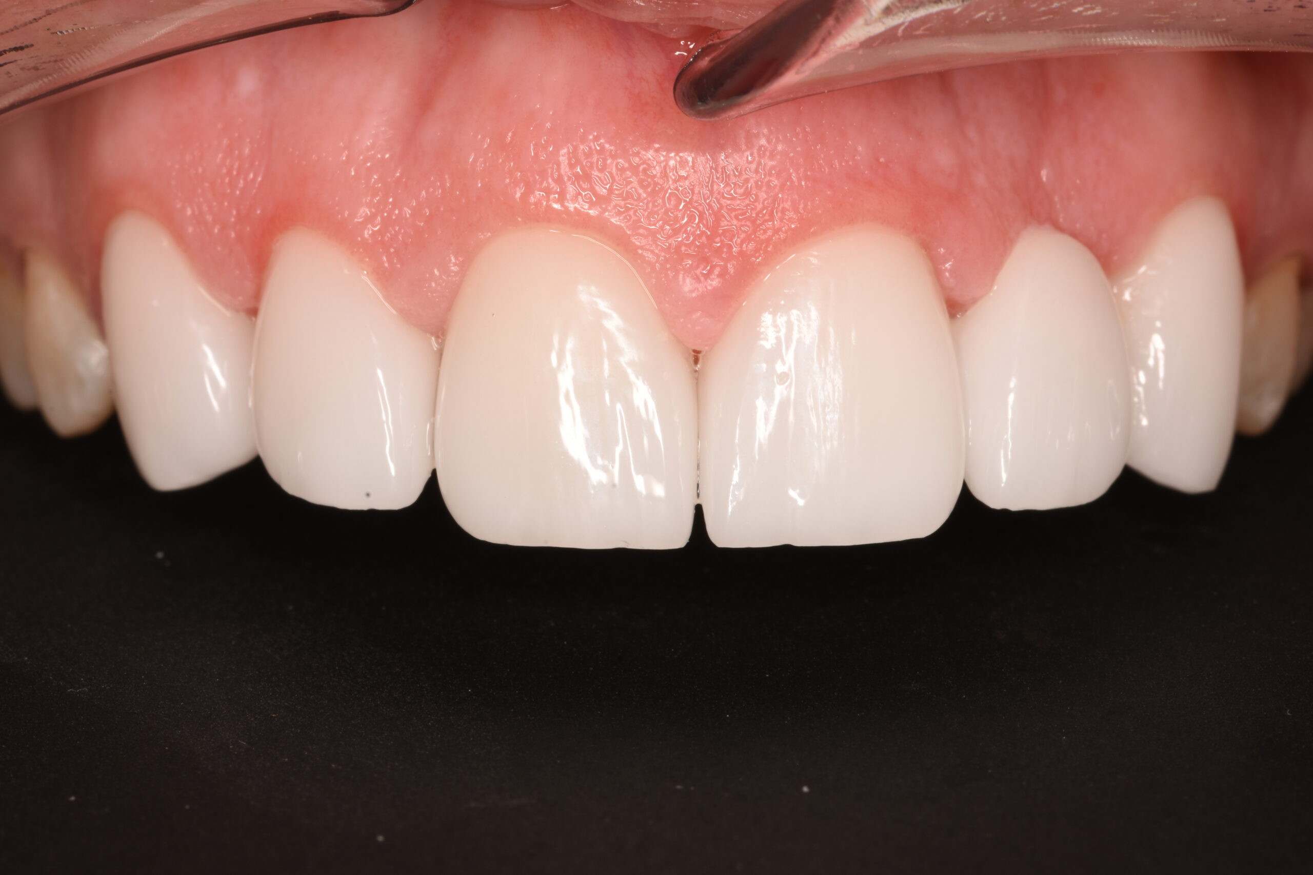 Smile makeover after