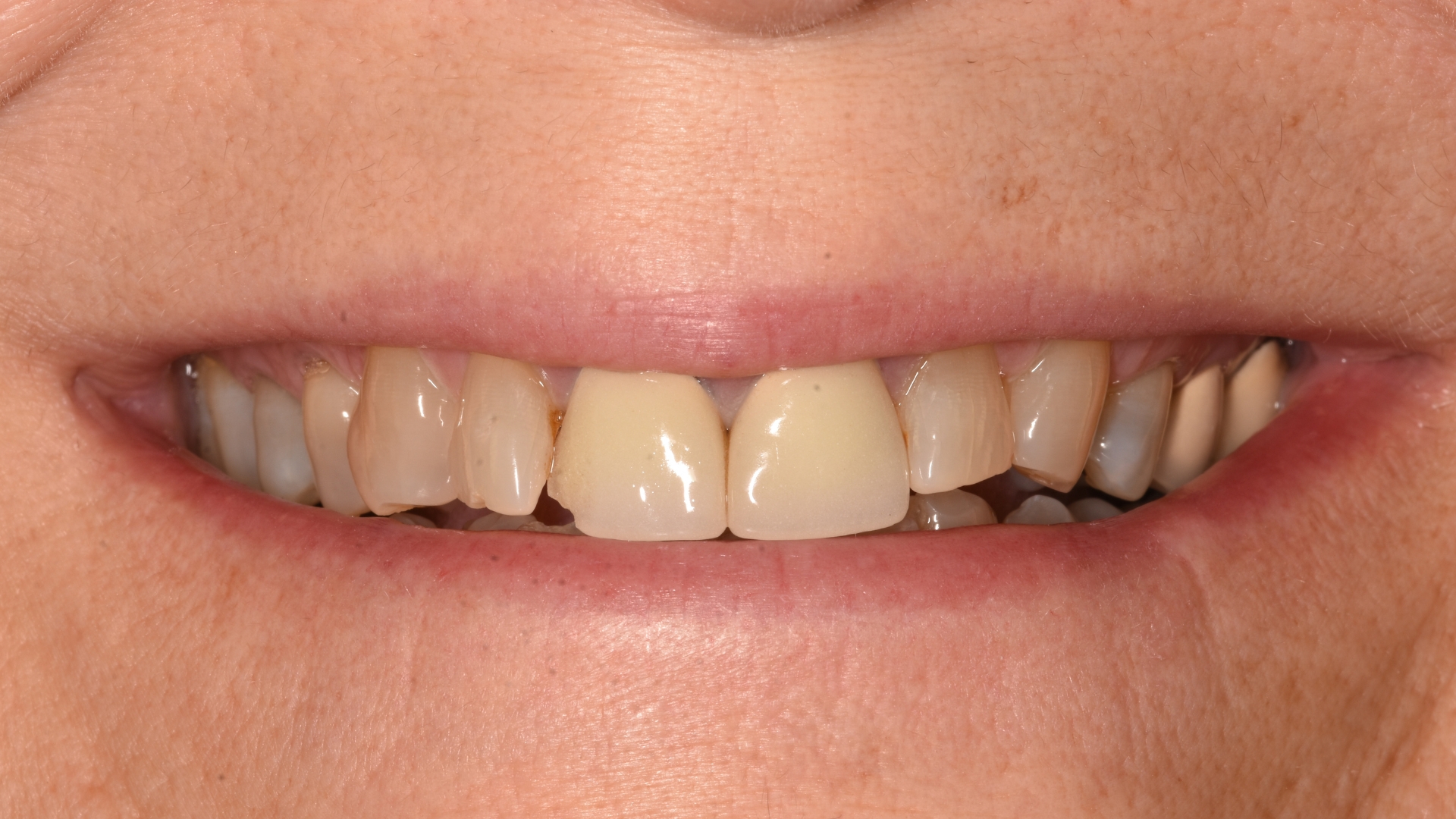 Smile makeover before