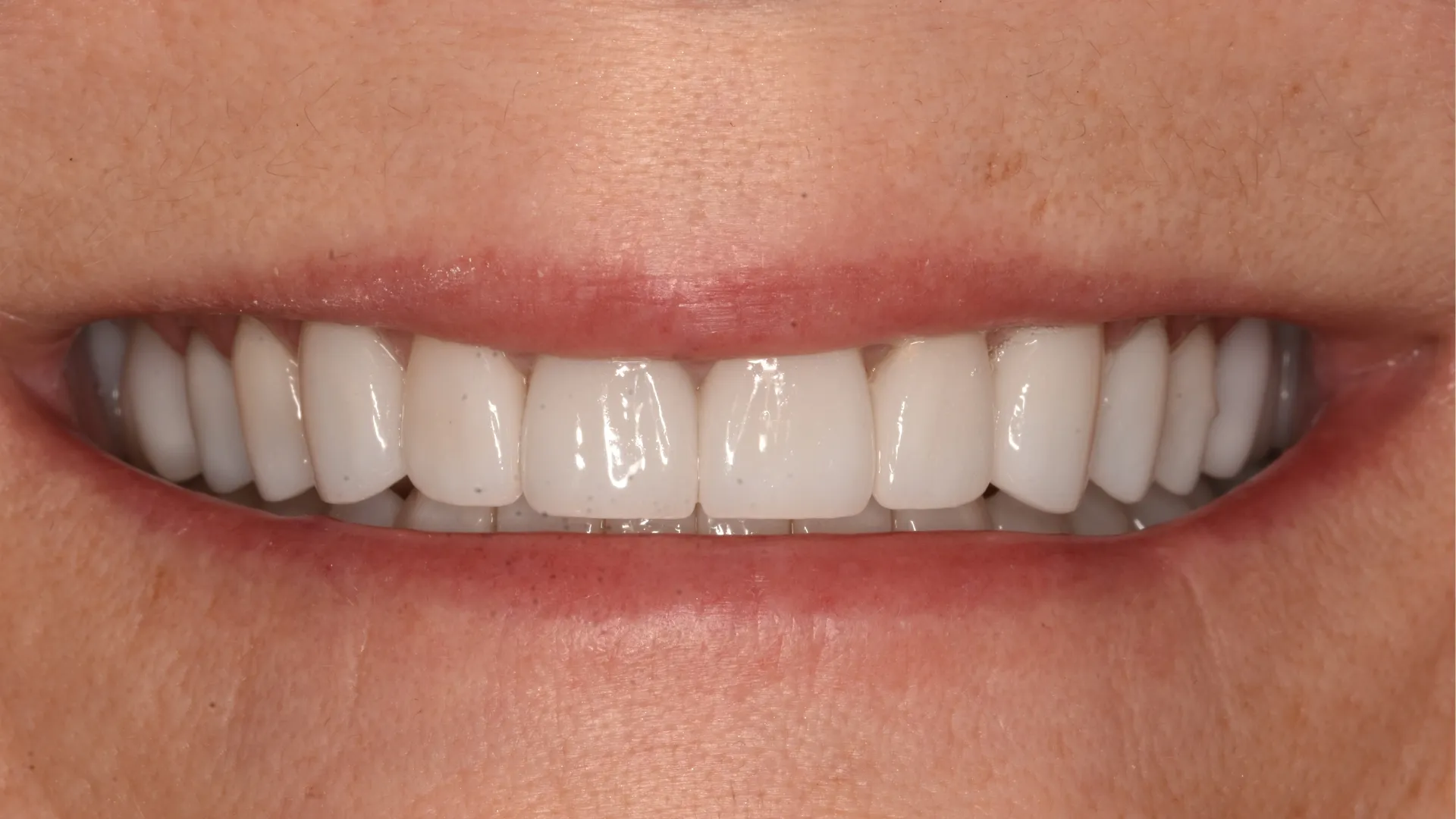 Smile makeover after