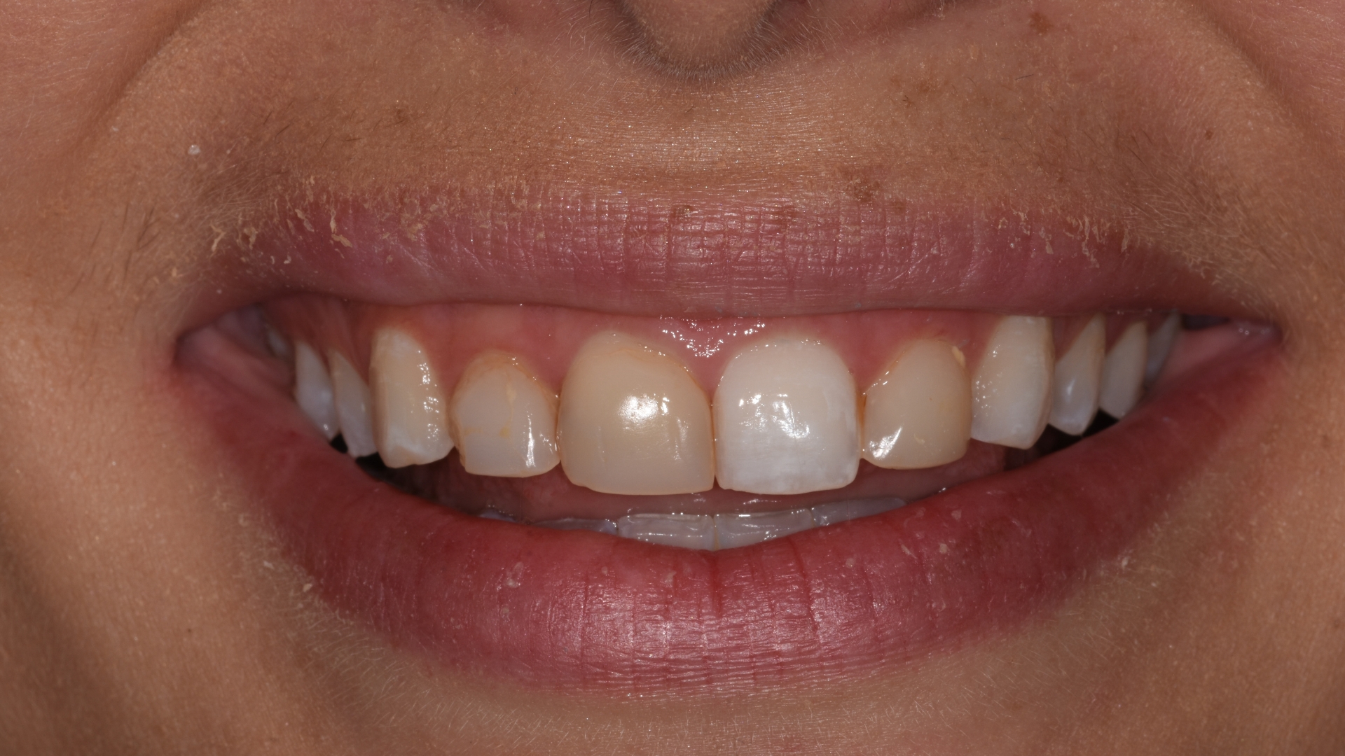 Smile makeover before