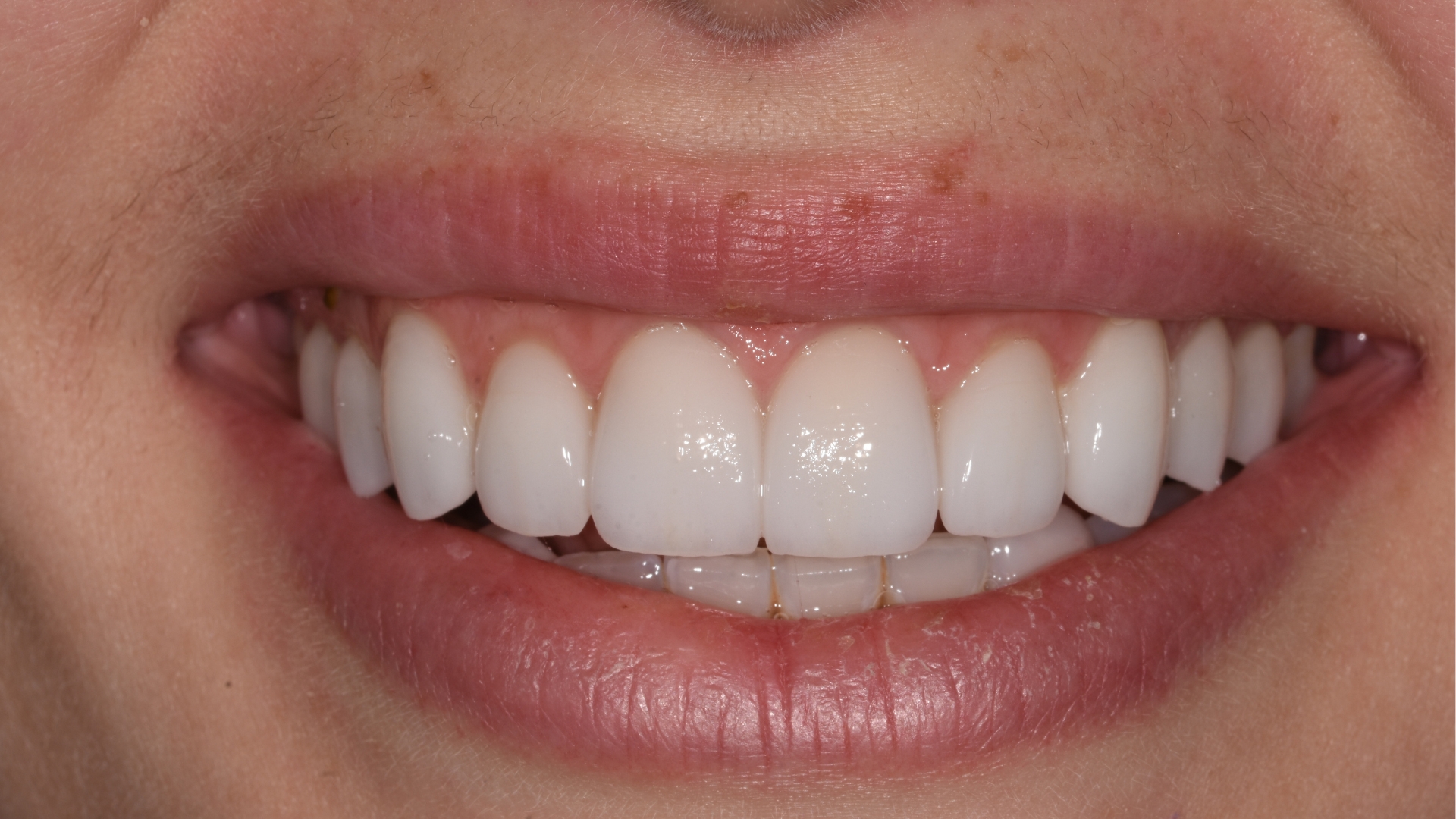 Smile makeover after